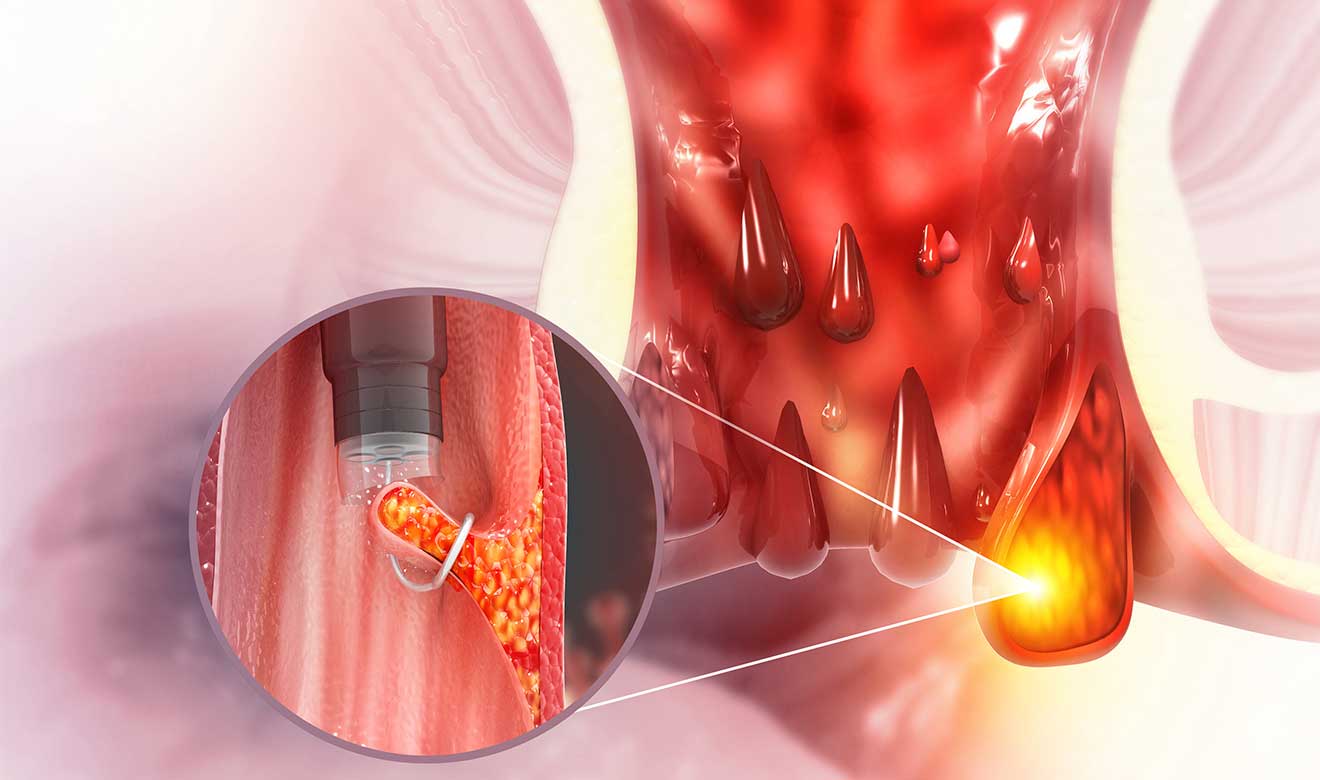 Hemorroides: romper el tabú para una mejor prevención y tratamiento -  Noticias Desde Veracruz